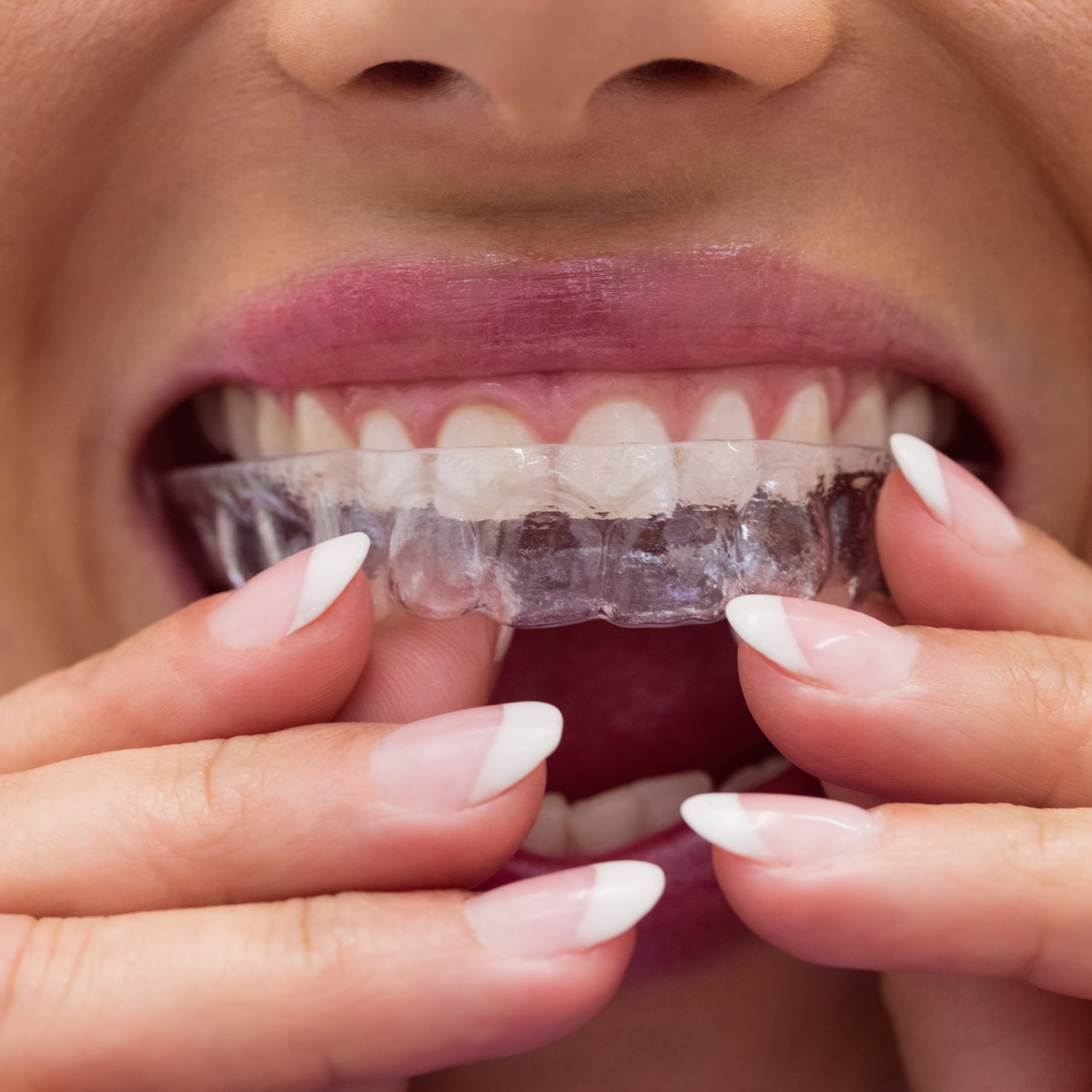 Aligners case for spacing at Dental Specialists Lahore