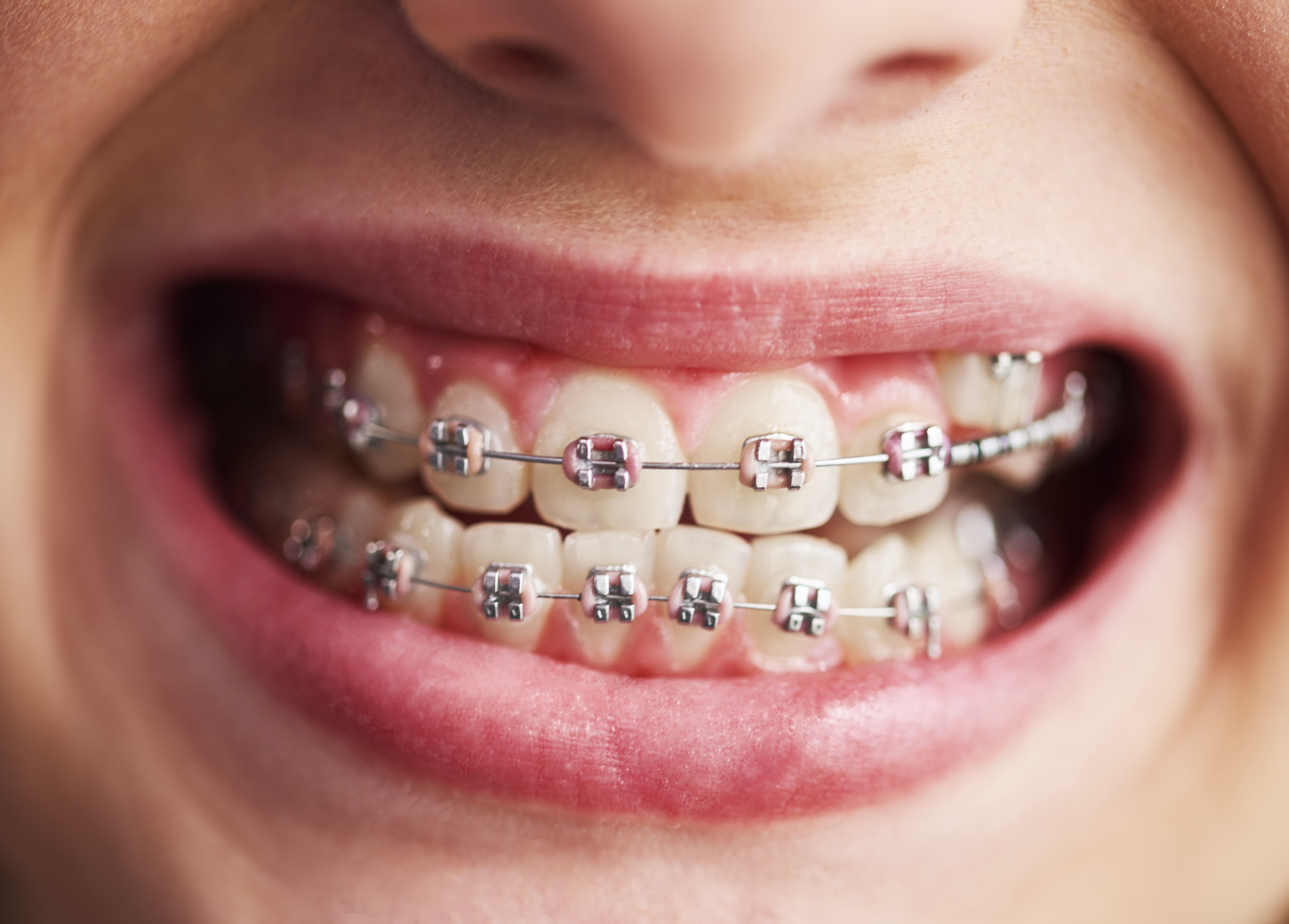 Braces case for crowded teeth at Dental Specialists Lahore