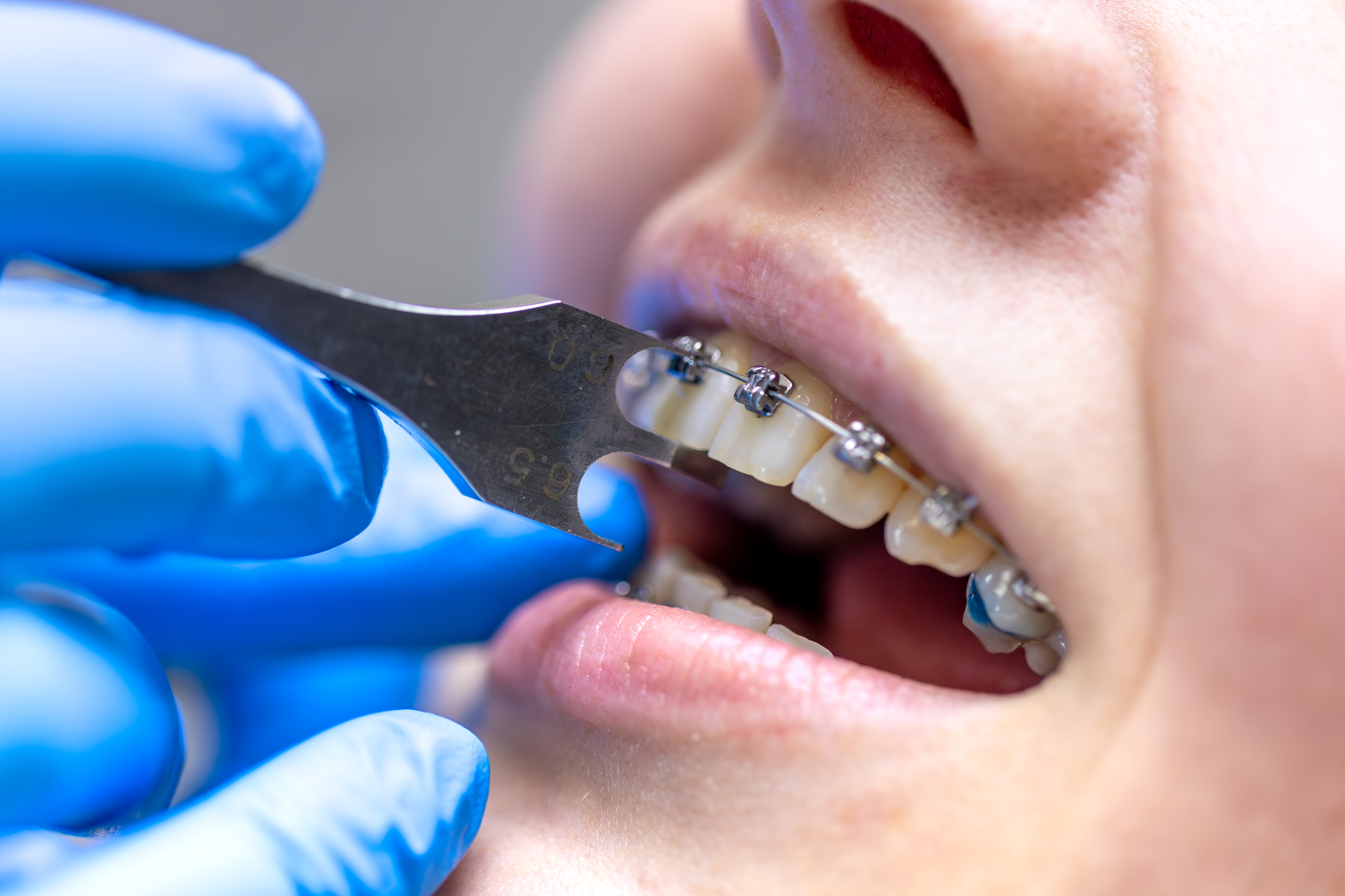 Braces and aligners in Lahore at Dental Specialists