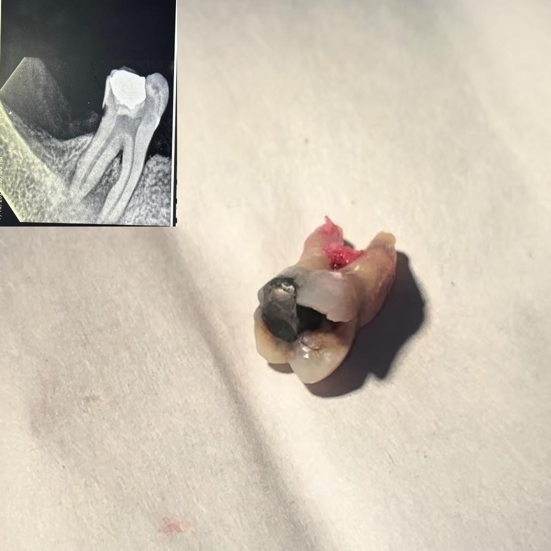 Close-up of a tooth being checked for sharp and lingering sensitivity