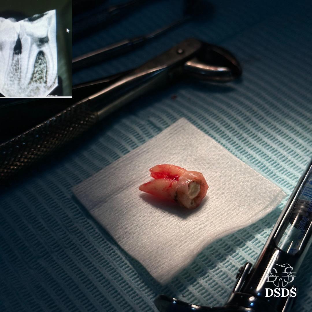 Close-up dental view relevant to bleeding after a tooth extraction