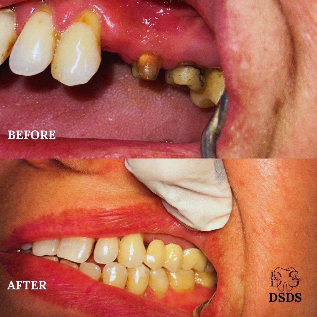 Single tooth implant case at Dental Specialists Lahore