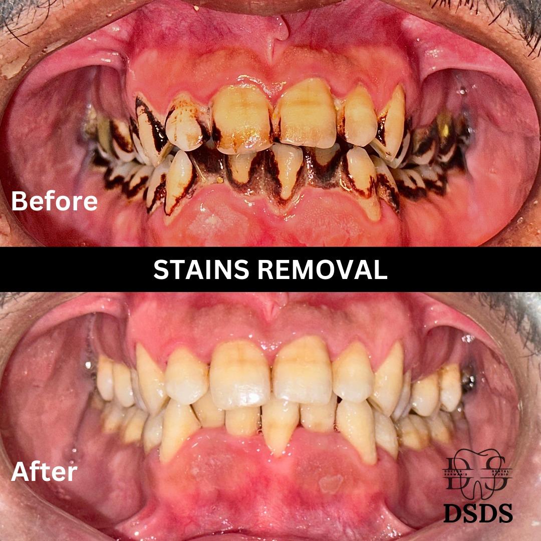 Gum health and cleaning case at Dental Specialists Lahore