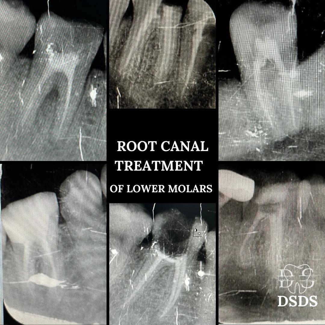 Root canal treatment case at Dental Specialists Lahore