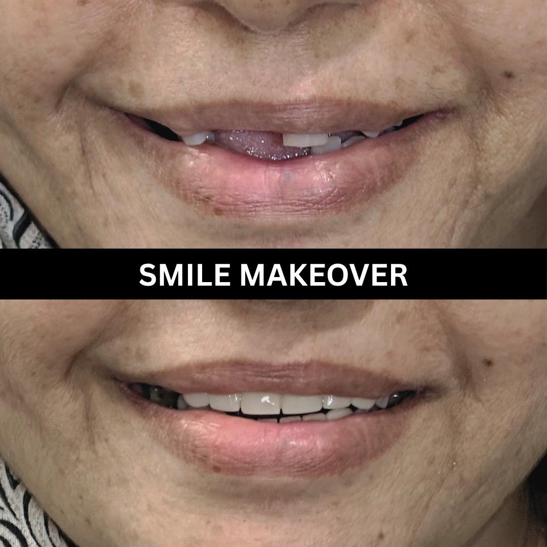 Veneers smile makeover case at Dental Specialists Lahore