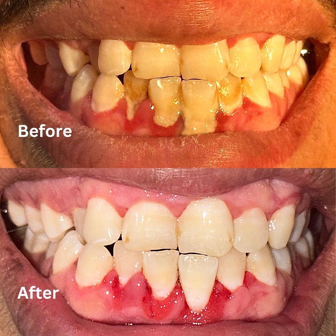 Scaling and polishing case at Dental Specialists Lahore