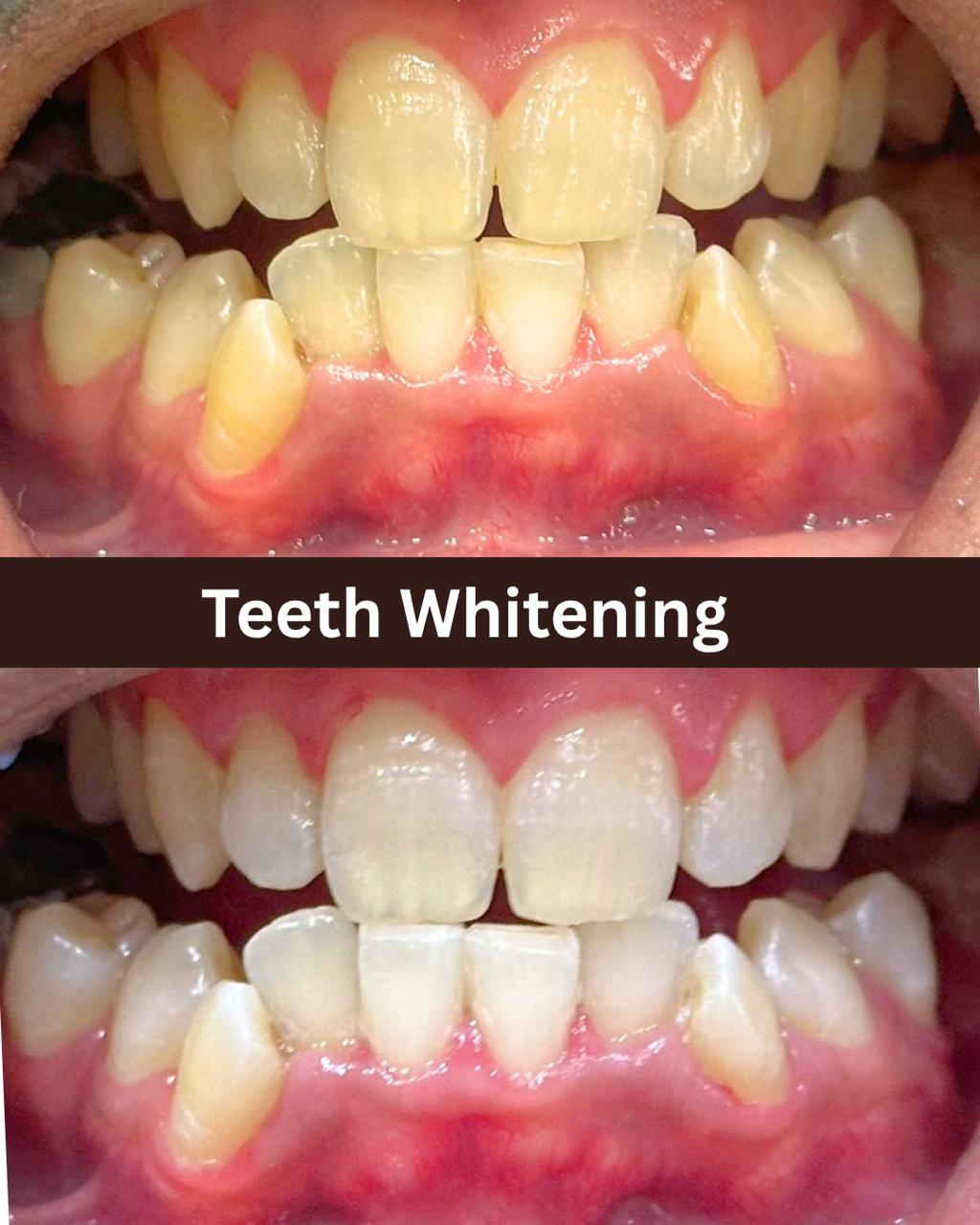 Teeth whitening case at Dental Specialists Lahore