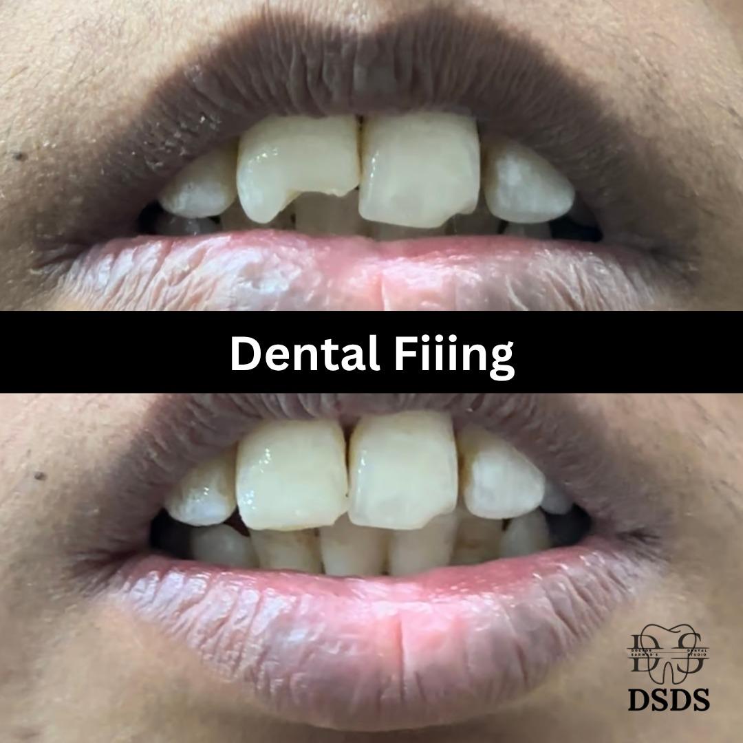 Dental bridge gap replacement case at Dental Specialists Lahore