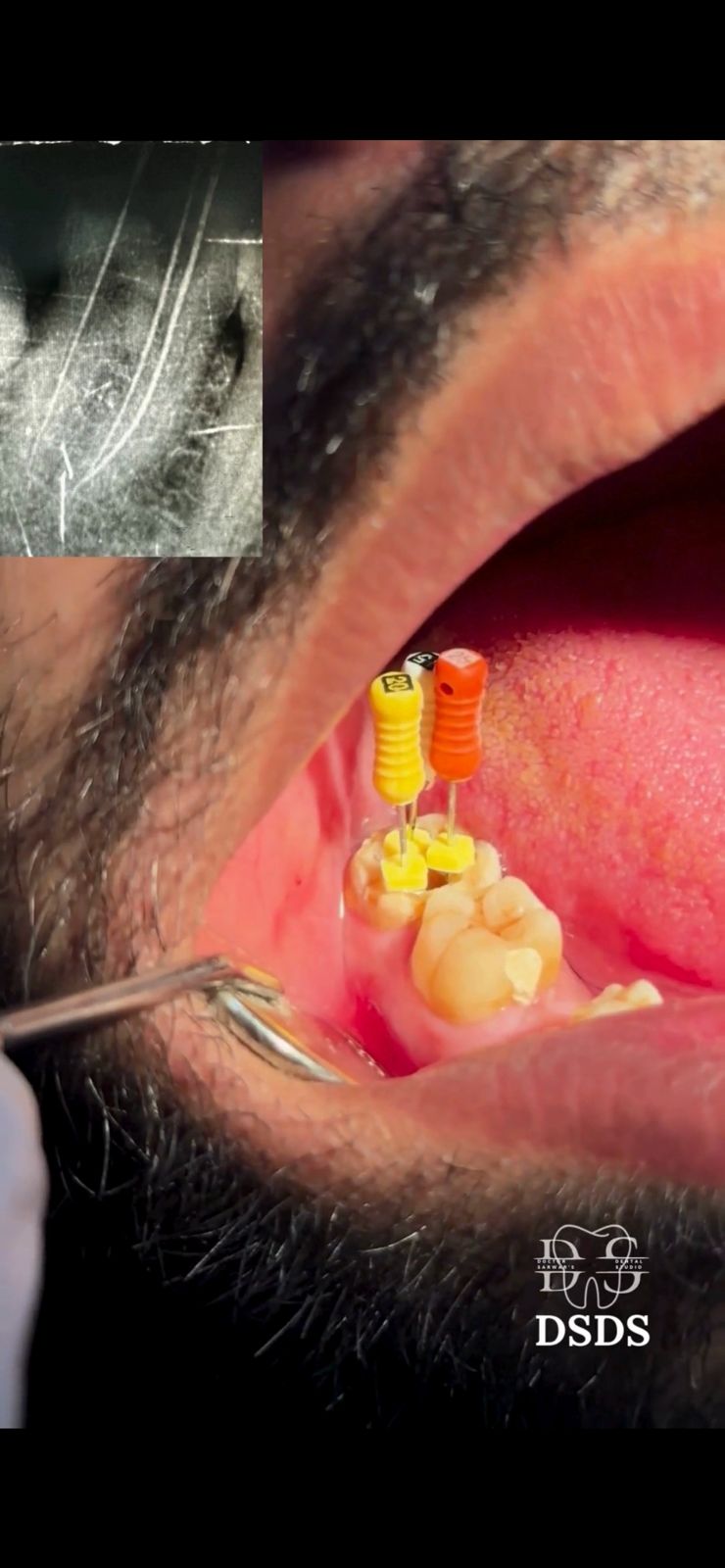 Early fillings treatment case at Dental Specialists Lahore