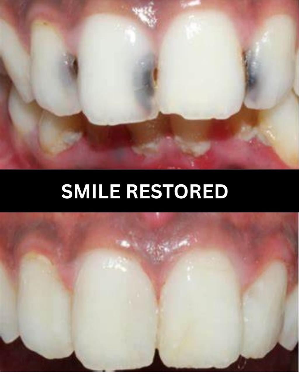 Combined whitening and veneers case at Dental Specialists Lahore