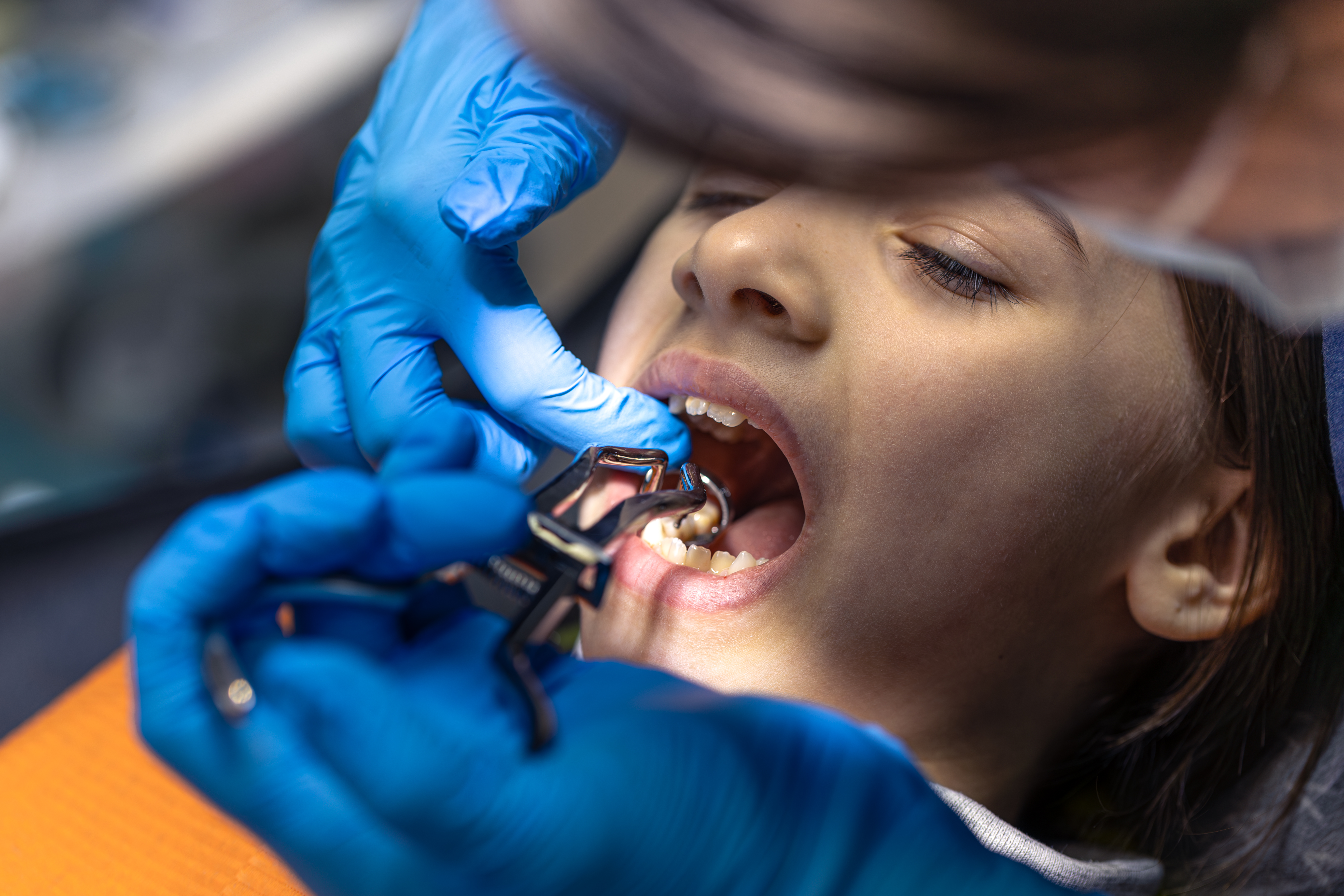 Dental sealants treatment at Dental Specialists Lahore