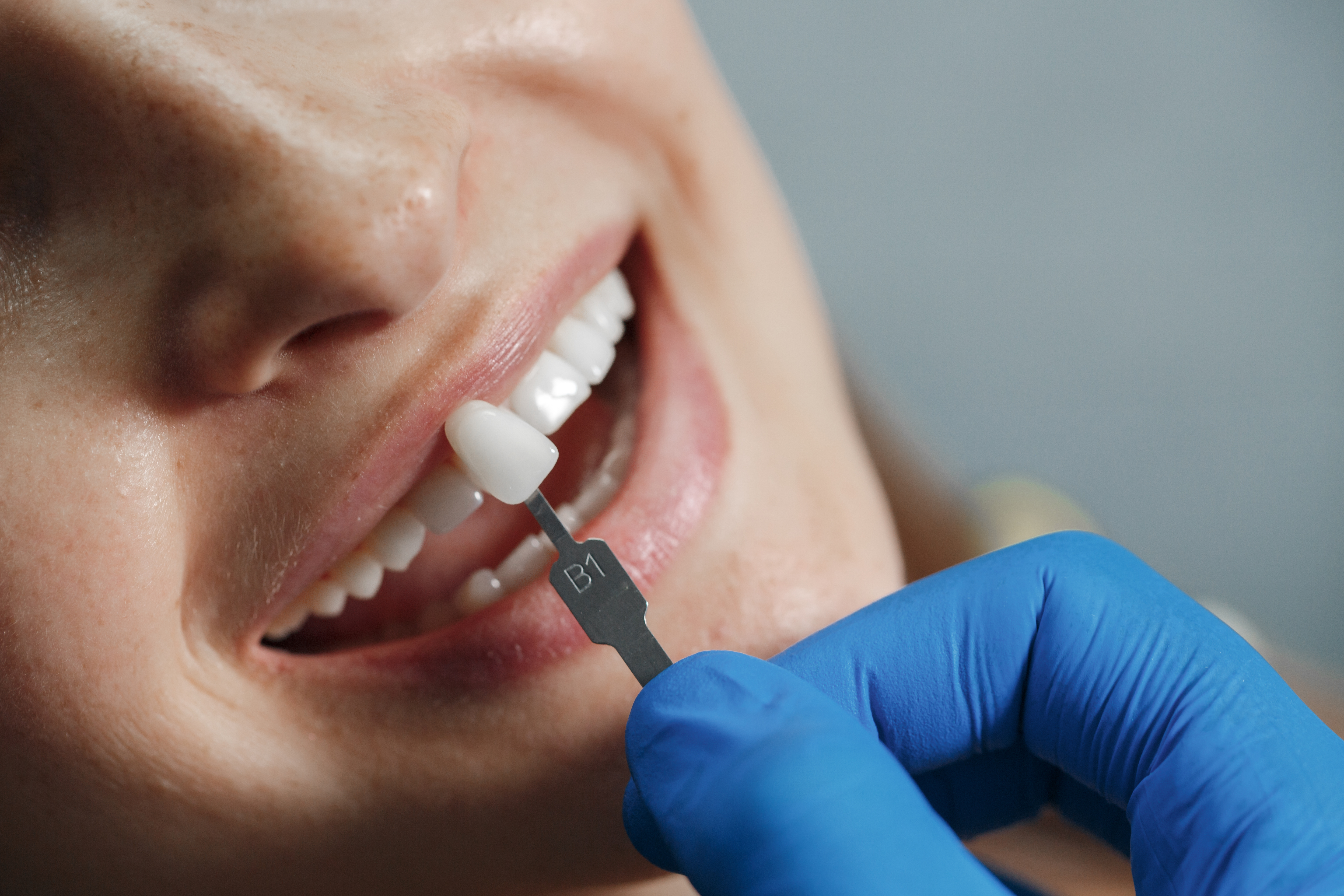 Veneers treatment at Dental Specialists Lahore